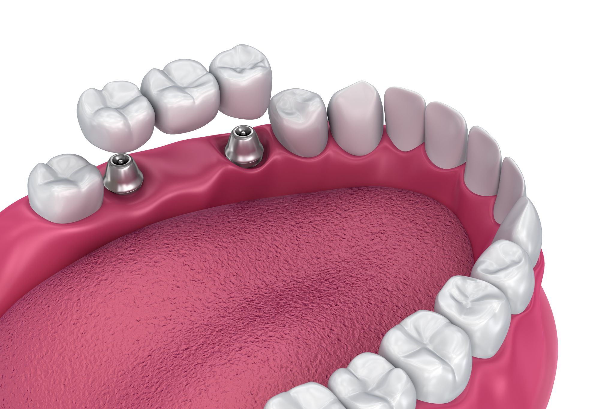 ponte fisso per denti - dentisti croazia